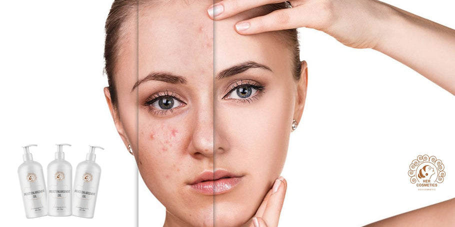 Wat is de meest effectieve crème voor de behandeling van acne?