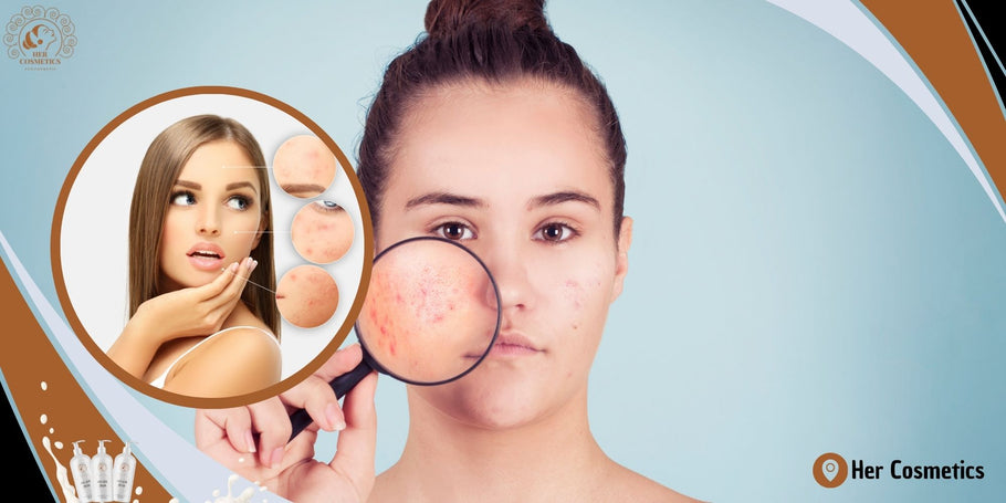 Wat zijn de stappen die u moet volgen om acne effectief te bestrijden?